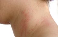 ¿Por qué tengo alergia a un alimento y qué debo hacer?
