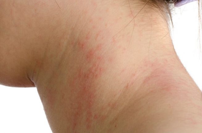 ¿Por qué tengo alergia a un alimento y qué debo hacer?