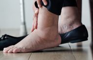 ¿Acumulas agua y presentas edema o hinchazón?