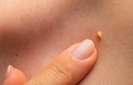 ¿Cómo se puede eliminar la infección por VPH?