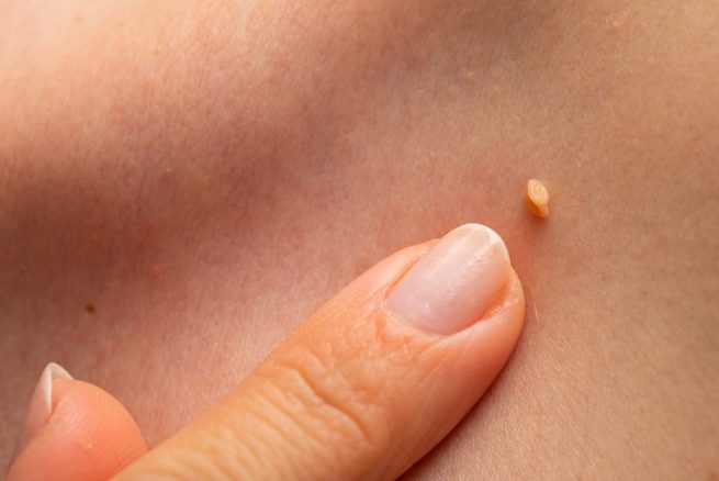 ¿Cómo se puede eliminar la infección por VPH?
