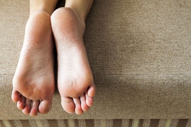 Consejos para eliminar los callos de los pies