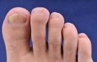 Consejos para eliminar los hongos de las uñas
