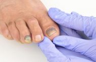 Hongos negros en las uñas: a qué se deben y cómo tratarlos