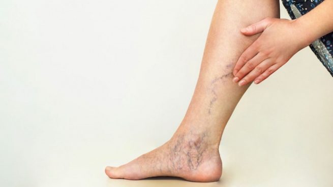 Cuando la neuropatía diabética afecta a las piernas y pies