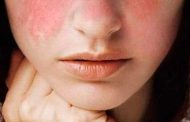 ¿Qué es el lupus eritematoso sistémico?