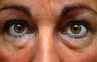 Bolsas debajo de los ojos: cómo deshacerse de ellas