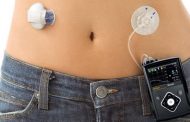 Páncreas Artificial, una alternativa para los diabéticos
