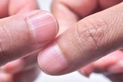 Qué hacer para eliminar las líneas o surcos en las uñas