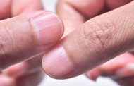 Qué hacer para eliminar las líneas o surcos en las uñas