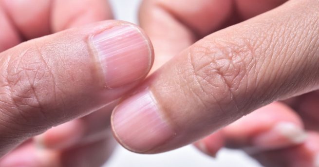 Qué hacer para eliminar las líneas o surcos en las uñas
