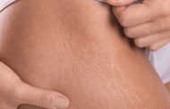 Qué remedios naturales ayudan a reducir la celulitis