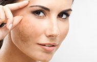 Cómo se puede tratar el melasma