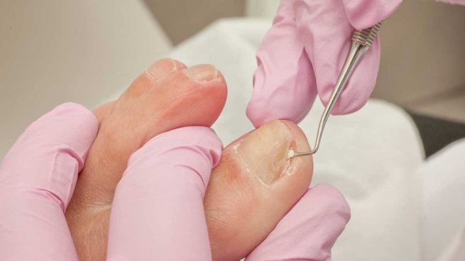 ¿Uñas encarnadas? Esto es lo que debes hacer