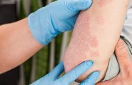 10 mitos y dudas frecuentes sobre la psoriasis