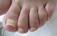 Hongos en las uñas: remedios para eliminarlos en casa