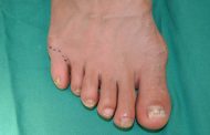 ¿Es normal tener seis dedos en una mano o pie?