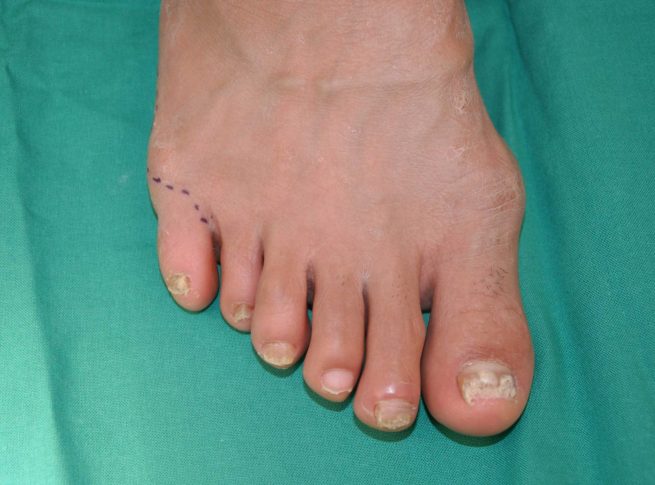 ¿Es normal tener seis dedos en una mano o pie?