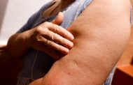El mundo supera los 50.000 casos de viruela del mono