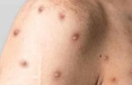 En el Cesar se confirma el primer caso de viruela símica