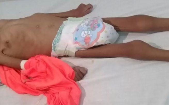 Procuraduría pide medidas urgentes para detener muertes por desnutrición en el país que alcanzan los 124 casos confirmados