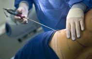 Liposucción, ¿qué tan efectiva es?