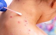En Colombia, avanza protocolo de atención para viruela símica