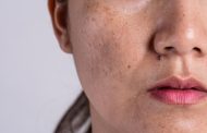 Cómo se puede tratar el melasma