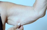 Qué es la sarcopenia y cuáles son sus síntomas