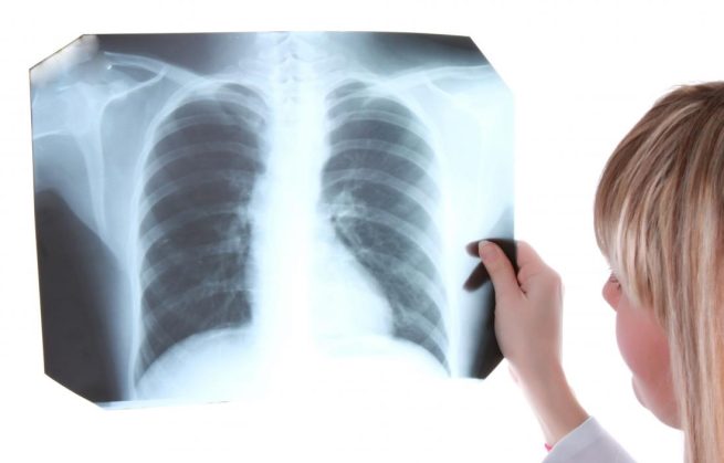 24 de marzo, Día Mundial de la Tuberculosis; buscan combatir la epidemia en el mundo