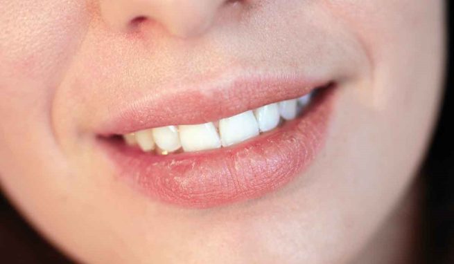 Por qué se agrietan los labios y cómo evitarlo