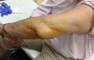 Bursitis: conoce los distintos tipos, sus síntomas, y tratamientos