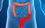 Se diagnostican más casos de cáncer de colon en jóvenes