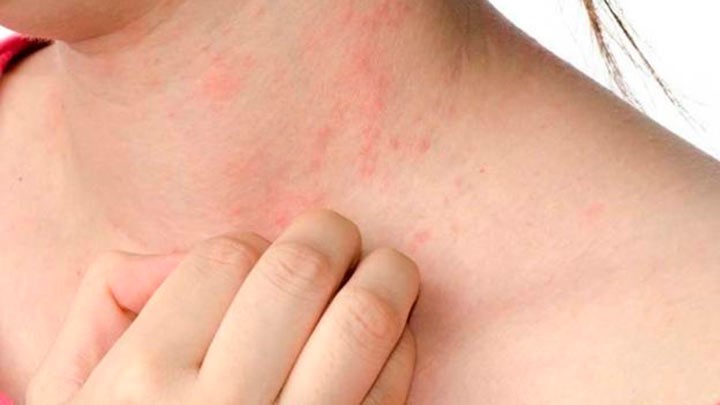 Qué se puede hacer para prevenir el cáncer de piel