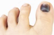 ¿Uñas que se oscurecen? Podría ser un hongo