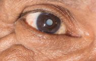 ¿A qué edad aparecen las cataratas?