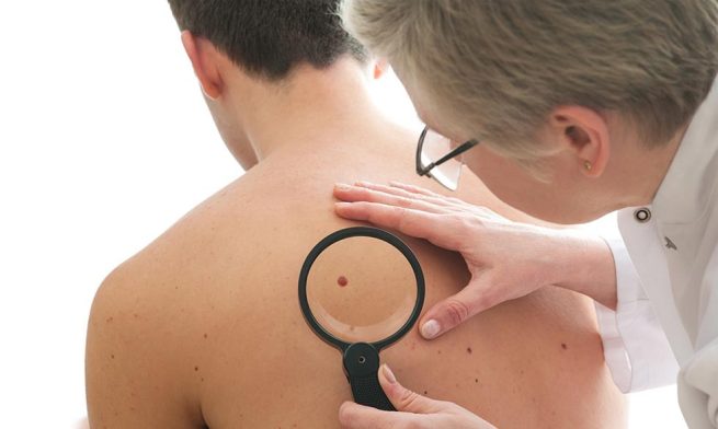 Cáncer de piel, uno de los más comunes en el mundo; ¿qué hacer y cómo evitarlo?