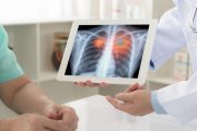 Algoritmo estima prevalencia de cáncer de pulmón en Colombia