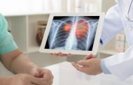 Algoritmo estima prevalencia de cáncer de pulmón en Colombia