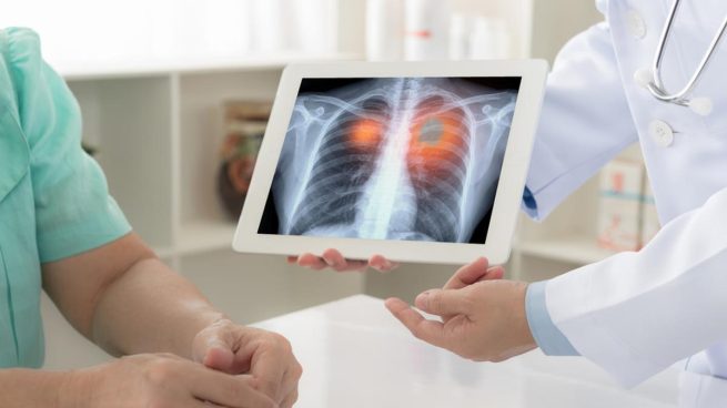 Algoritmo estima prevalencia de cáncer de pulmón en Colombia