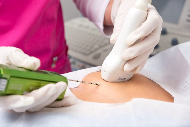 Biopsias, aliadas en la identificación de residuos de tejido cancerígeno de tiroides