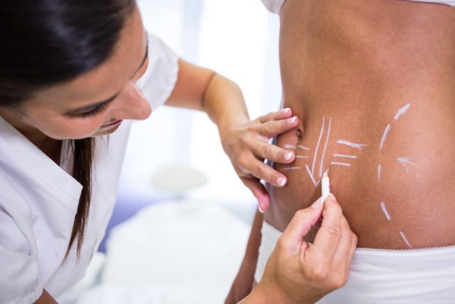 La liposucción no es una fórmula mágica y tiene un riesgo al que la mayoría no presta atención