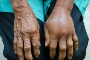 La inflamación de manos y pies puede ser señal de una enfermedad delicada