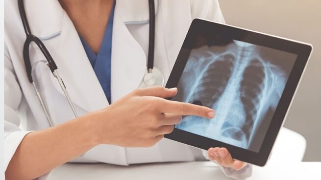 ¿Por qué el de pulmón es el cáncer que más mata en el mundo?