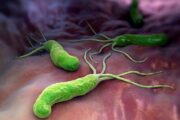 Infección por H. pylori y su relación con la úlcera péptica