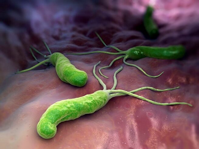 Infección por H. pylori y su relación con la úlcera péptica