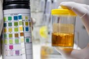 Qué significan los distintos colores de la orina