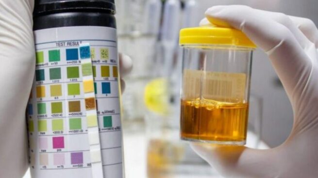 Qué significan los distintos colores de la orina