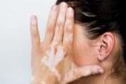 Vitiligo, la enfermedad de la piel que a pesar de ser común es muy poco conocida