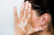 Vitiligo, la enfermedad de la piel que a pesar de ser común es muy poco conocida